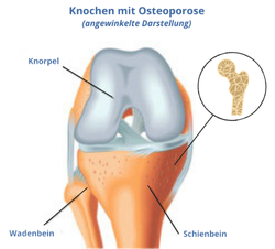 Abbildung Osteoporose im Knochen