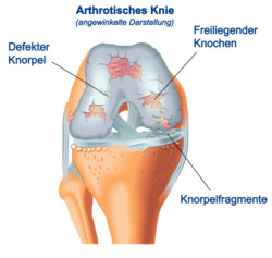 artheotisches Knie